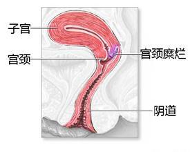 宫颈糜烂
