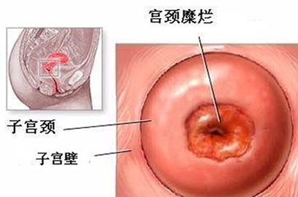 宫颈糜烂