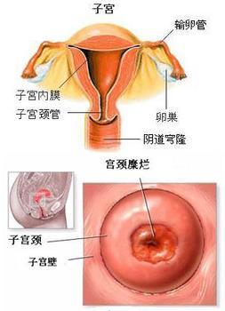 宫颈糜烂