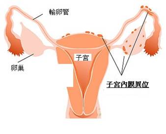 子宫内膜异位