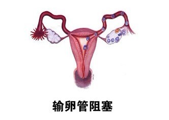 输卵管堵塞