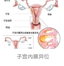 子宫内膜异位