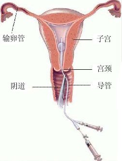 子宫