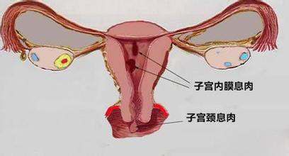 宫颈息肉