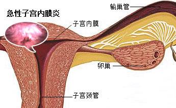 子宫内膜炎