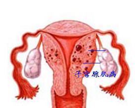 子宫腺肌症