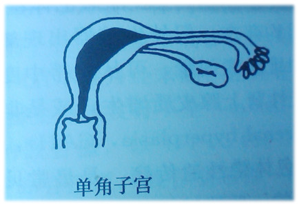 单角子宫
