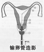 输卵管造影