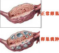 卵巢囊肿