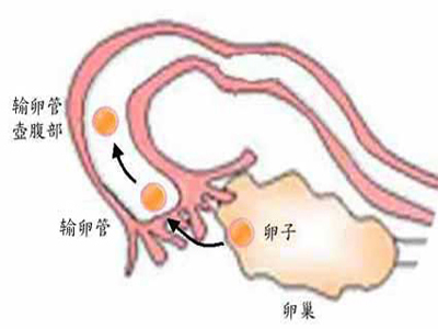 输卵管炎