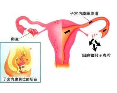 女性不孕