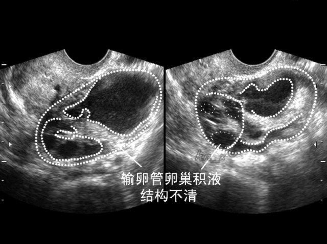 输卵管积水