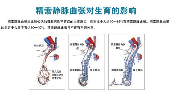 精索静脉曲张的危害