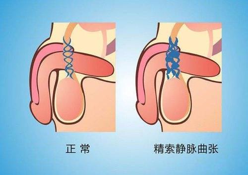 精索静脉曲张的原因