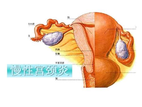 得了宫颈炎怎么办