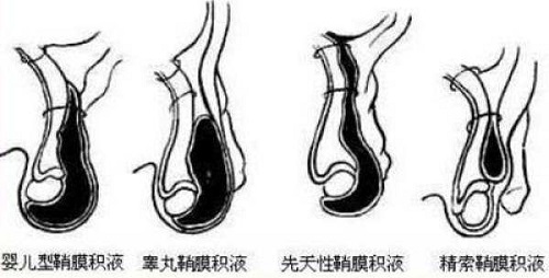 鞘膜积液的症状