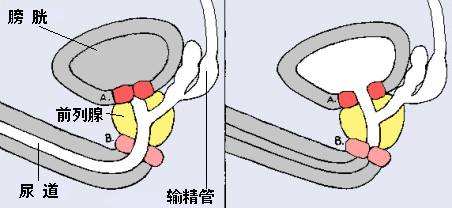 输精管堵塞有什么症状吗