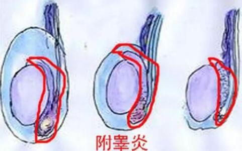 附睾炎传染吗