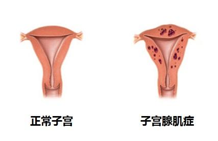 子宫腺肌要切除子宫吗